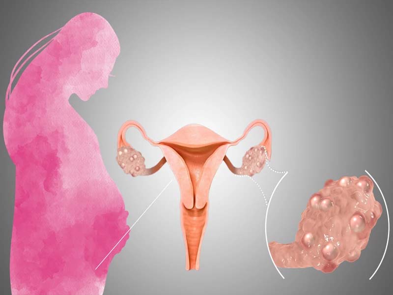 عوارض تنبلی تخمدان و بارداری