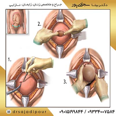 بعد از سزارین می‌توان زایمان طبیعی انجام داد؟