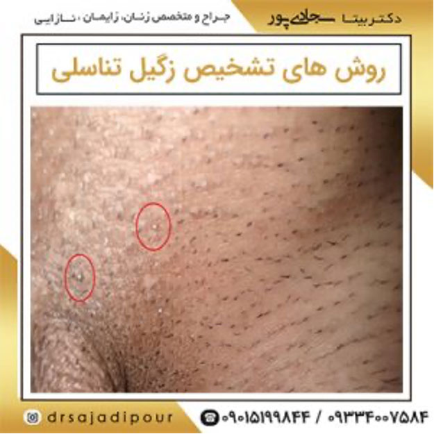 روش های تشخیص زگیل تناسلی