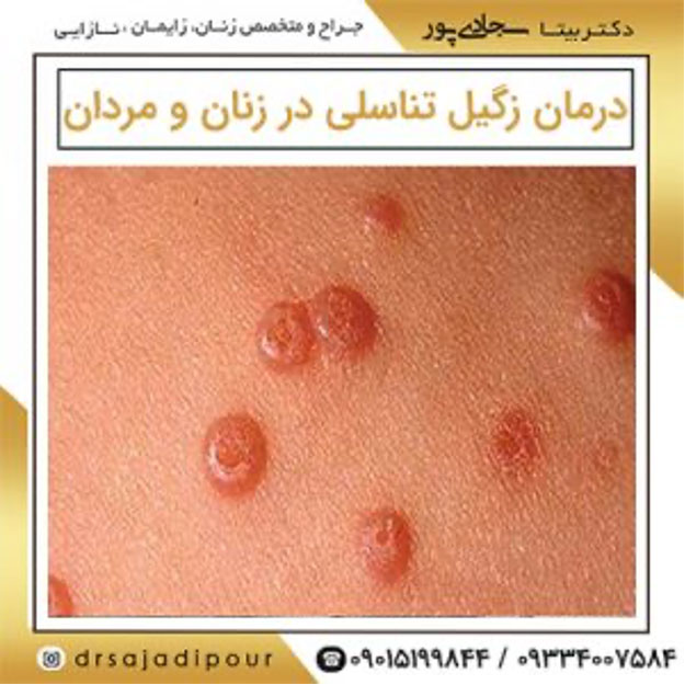 روش پیشگیری از بروز زگیل تناسلی 