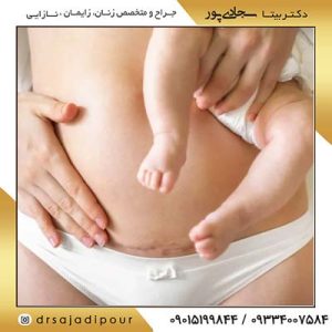 مزایای زایمان و مینی ابدومینوپلاستی همزمان