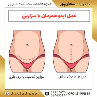 عمل ابدو همزمان با سزارین