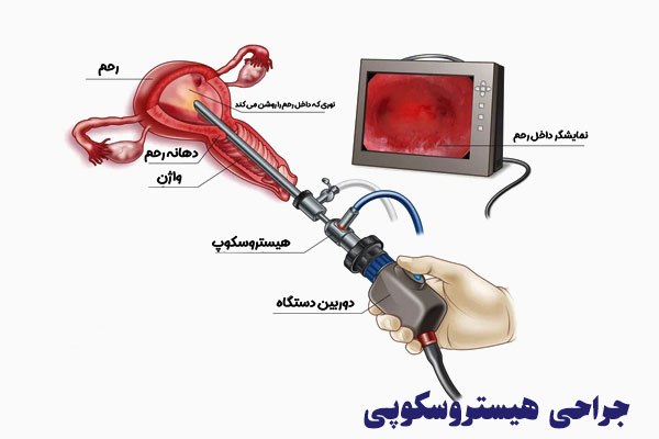 هیستروسکوپی رحم