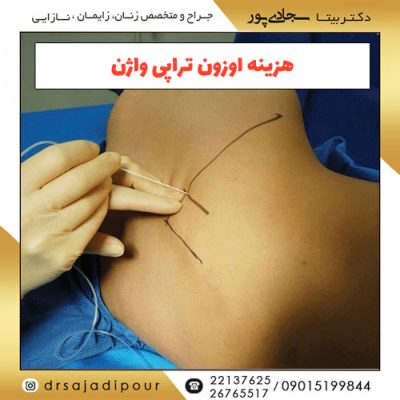 هزینه اوزون تراپی واژن