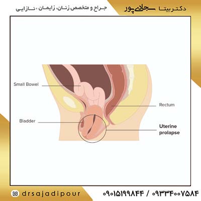 علل افتادگی واژن