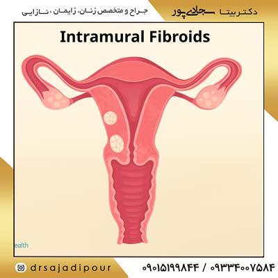 علائم فیبروم رحم