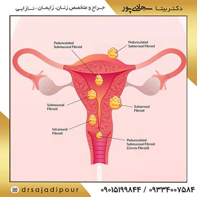 فیبروم رحم: علائم، تشخیص و درمان [متخصص زنان و زایمان]