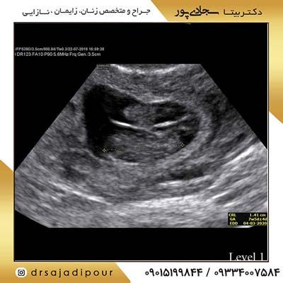 نحوه انجام سونوگرافی NT