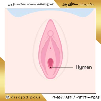 تکنیک‌های جراحی ترمیم پرده بکارت
