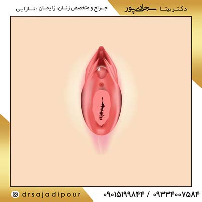 راهنمای جامع ترمیم پرده بکارت [هایمنوپلاستی] متخصص زنان