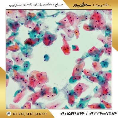 روش های تشخیص سرطان واژن