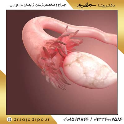 انتخاب بهترین روش جراحی اووفورکتومی