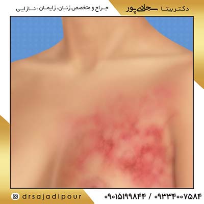 عوامل ژنتیکی و ارثی در سرطان پستان