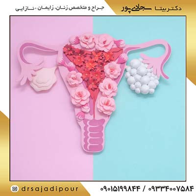 سندرم تخمدان پلی کیستیک: یک بررسی جامع