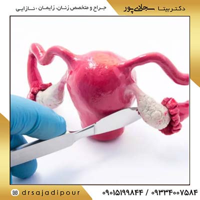دلایل نیاز به برداشتن تخمدان