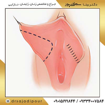 تجربیات رابطه جنسی بعد از لابیاپلاستی