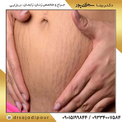 افتادگی رحم بعد از زایمان